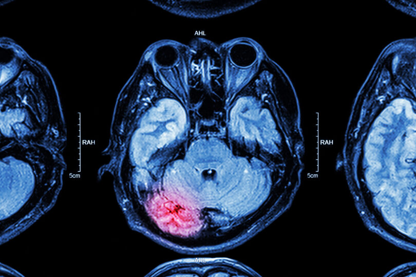 What are the Types of Traumatic Brain Injuries?