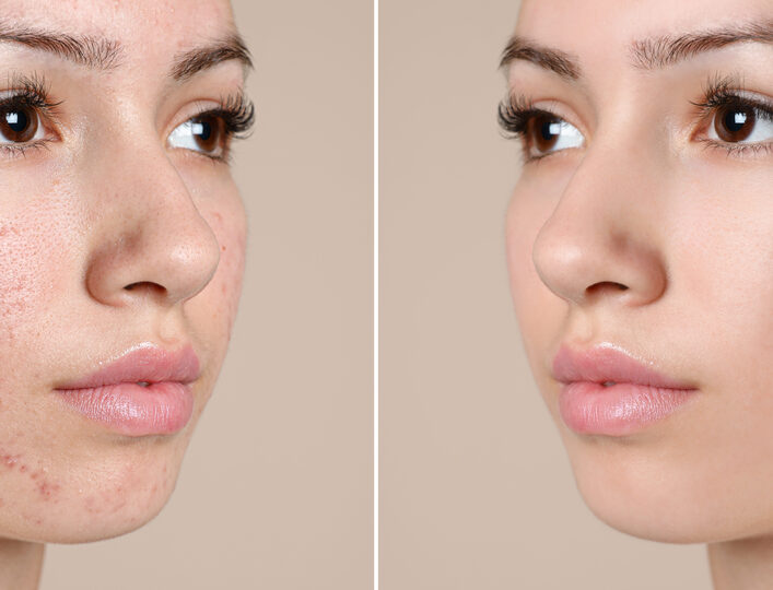 Acne: Causes, Treatment Options, Tips and Advice